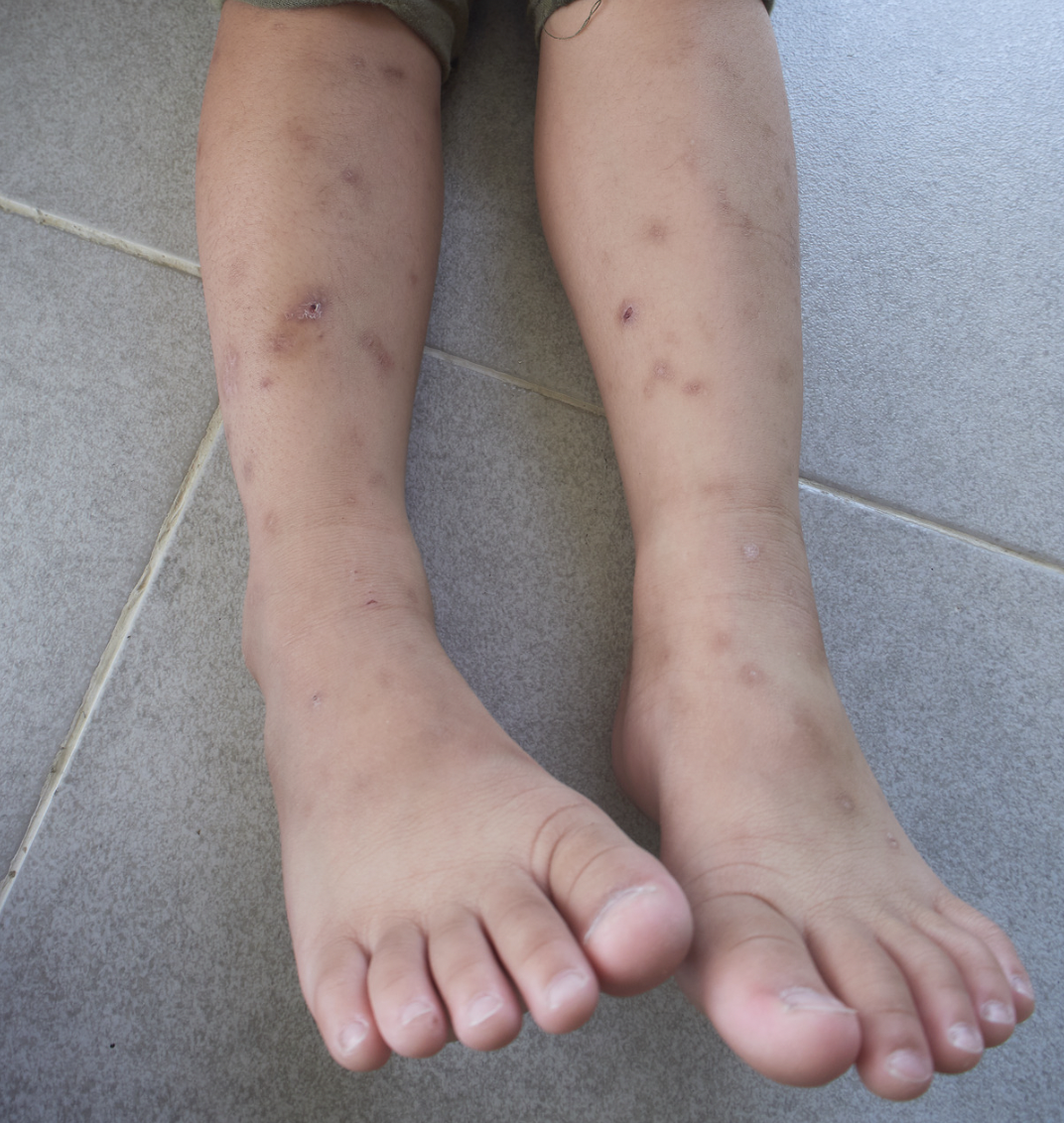 dermatology-surgery-dsa-bronx-ny-rocky-mountain-spotted-fever-1