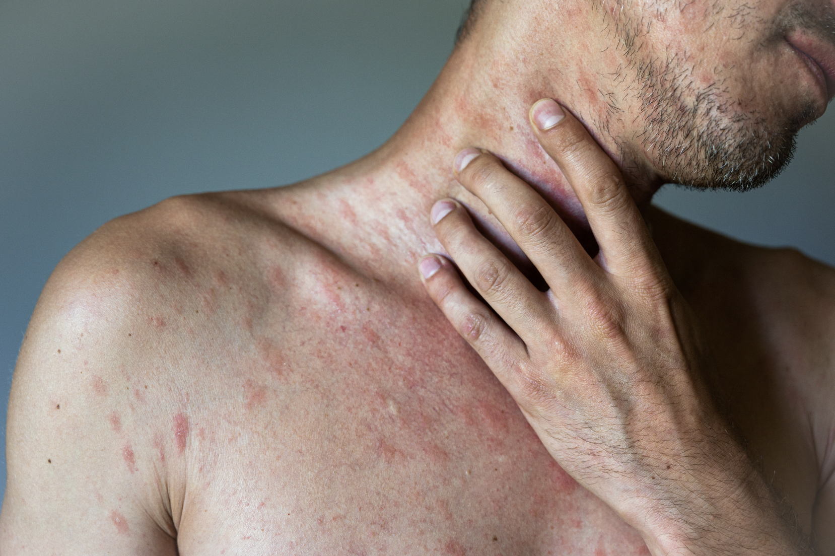 dermatology-surgery-dsa-bronx-ny-rocky-mountain-spotted-fever