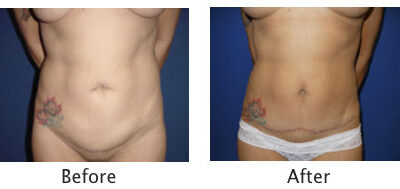 Abdominoplasty Tummy Tuck
