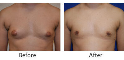 Male Breast Reduction Gynecomastia