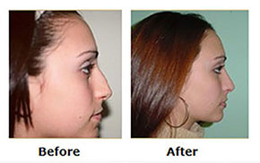 Rhinoplasty