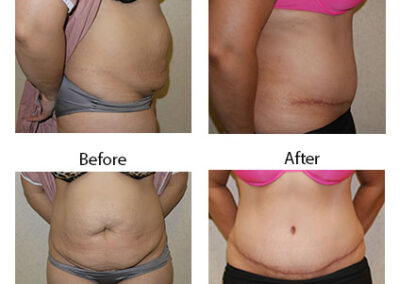 Abdominoplasty Tummy Tuck