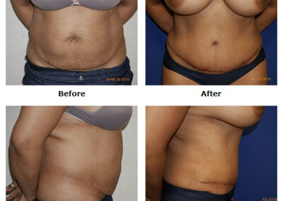 Abdominoplasty Tummy Tuck
