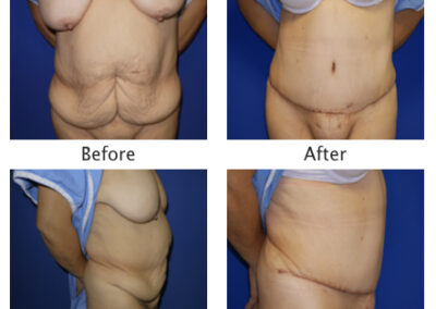 Abdominoplasty Tummy Tuck