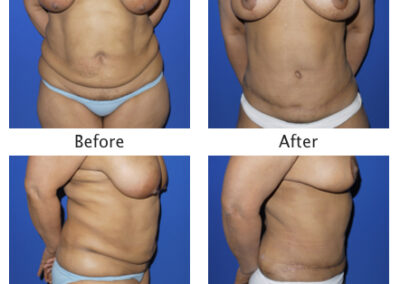 Abdominoplasty Tummy Tuck