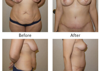 Abdominoplasty Tummy Tuck