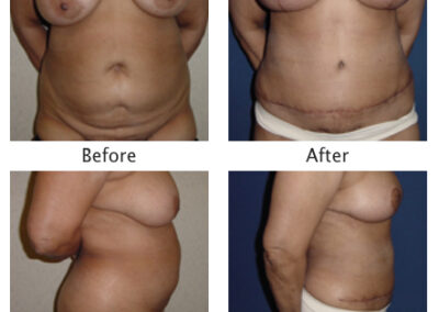 Abdominoplasty Tummy Tuck