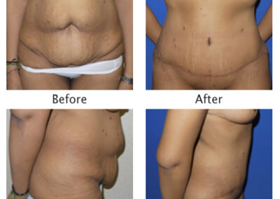 Abdominoplasty Tummy Tuck
