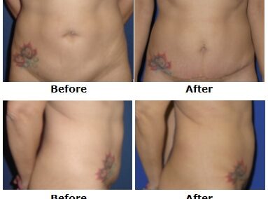 Abdominoplasty Tummy Tuck
