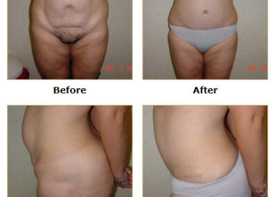Abdominoplasty Tummy Tuck