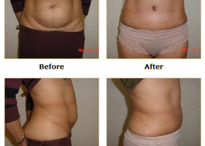 Abdominoplasty Tummy Tuck