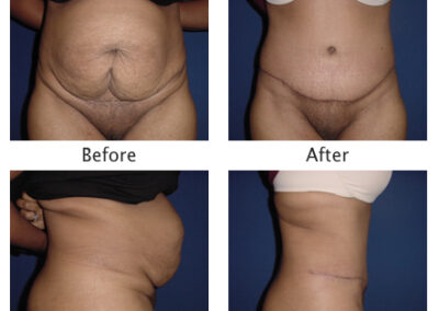 Abdominoplasty Tummy Tuck
