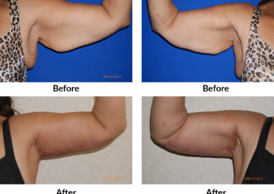 Arm Lift