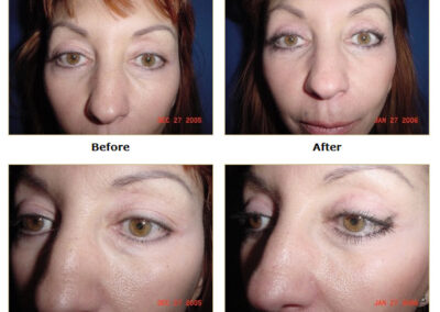Blepharoplasty