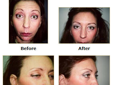 Botox