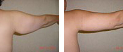 Arm Lift