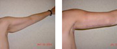 Arm Lift