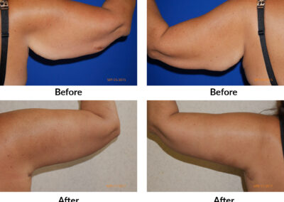 Arm Lift