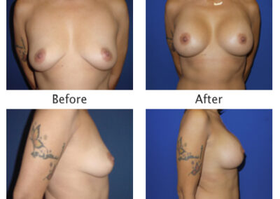 Breast Augmentation