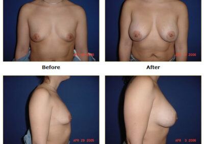 Breast Augmentation