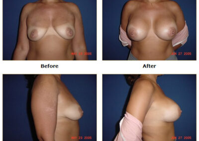 Breast Augmentation
