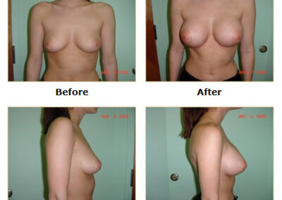 Breast Augmentation