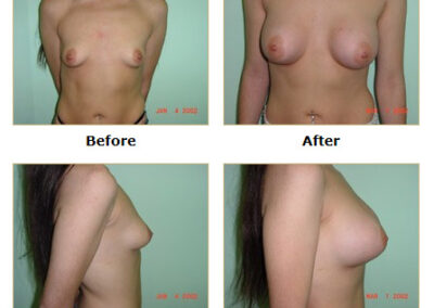 Breast Augmentation