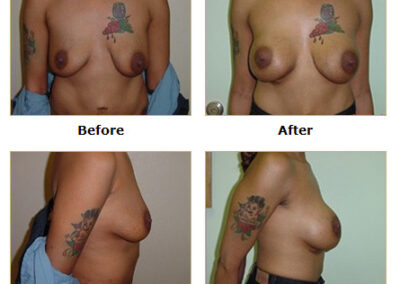 Breast Augmentation