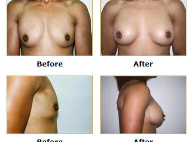 Breast Augmentation