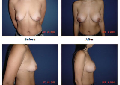 Breast Augmentation