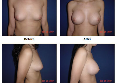 Breast Augmentation