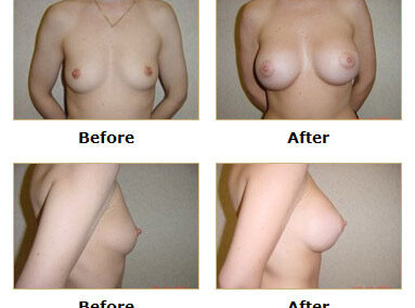 Breast Augmentation