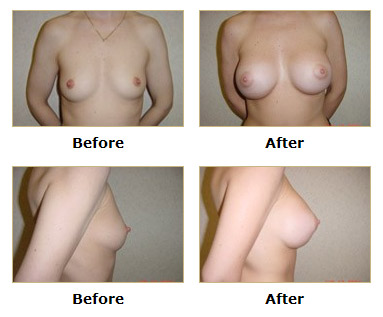 dermatology and surgery associates breast augmentation before and after bronx ny dermatology and surgery associates breast augmentation before and after bronx ny