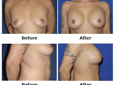 Breast Augmentation