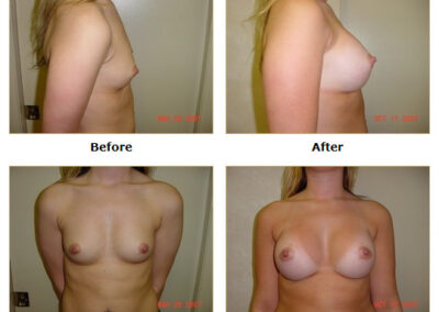 Breast Augmentation