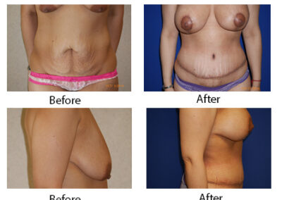 Breast Augmentation