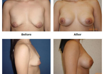 Breast Augmentation