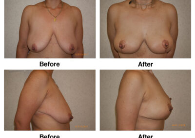 Breast Lift