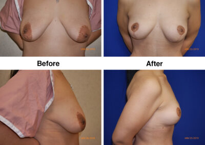 Breast Lift