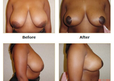 Breast Reduction