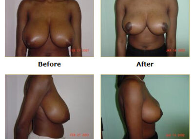 Breast Reduction