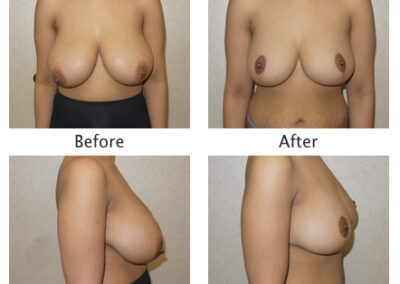Breast Reduction