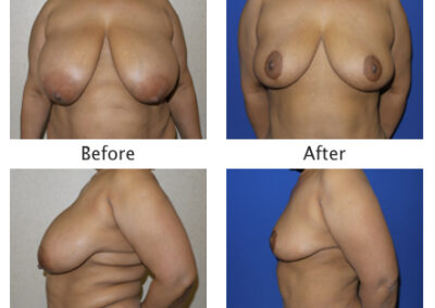 Breast Reduction