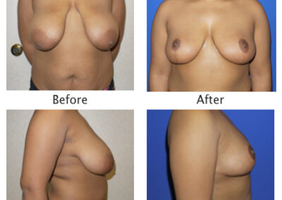 Breast Reduction