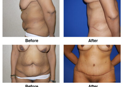 Abdominoplasty Tummy Tuck