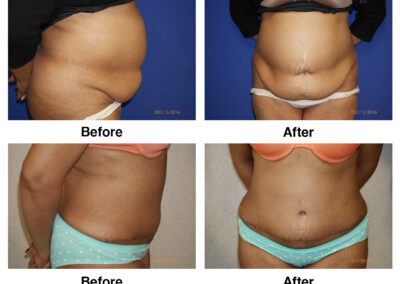Abdominoplasty Tummy Tuck
