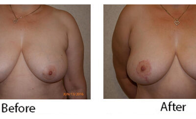 Breast Lift