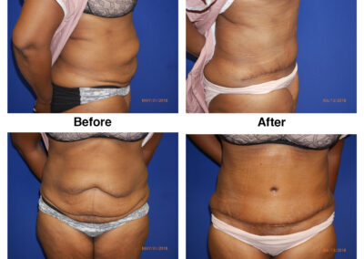 Abdominoplasty Tummy Tuck