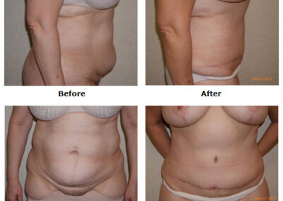 Abdominoplasty Tummy Tuck