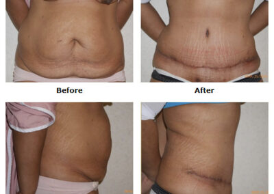 Abdominoplasty Tummy Tuck